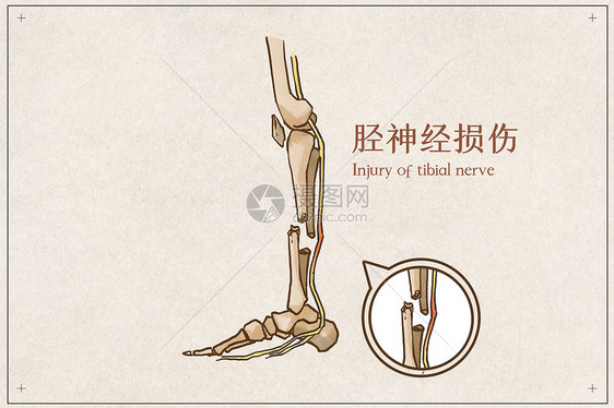 胫神经损伤病例医疗插画图片