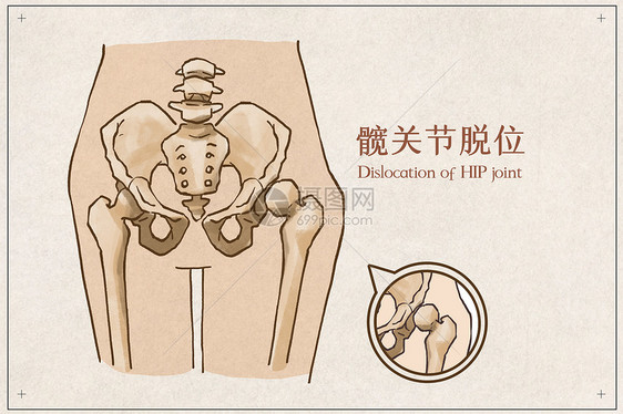 髋关节脱位病例医疗插画图片