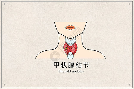 甲状腺结节医疗插画图片