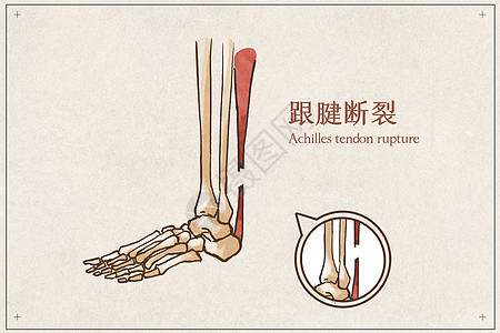 跟腱断裂病例医疗插画图片