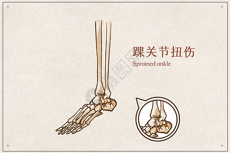 踝关节扭伤病例医疗插画高清图片