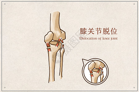 膝关节脱位骨骼骨外科高清图片