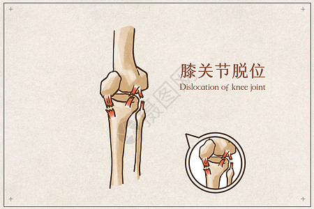 膝关节脱位图片