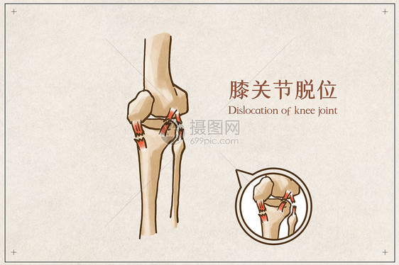 膝关节脱位图片