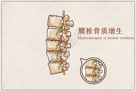 腰椎骨质增生图片