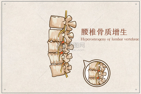 腰椎骨质增生图片