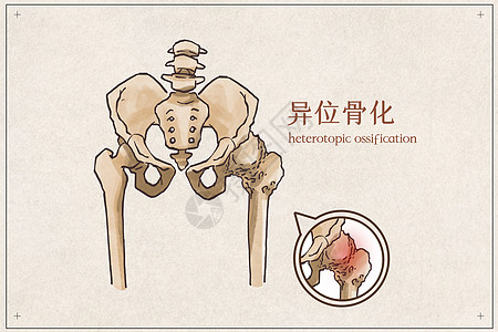 骨细胞异位骨化插画