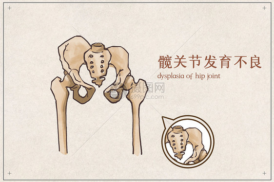 髋关节发育不良图片