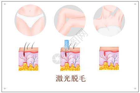 激光脱毛医美插画背景图片