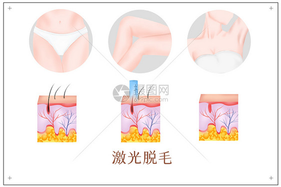 激光脱毛医美插画图片