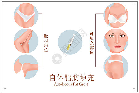 腰腹塑形医美自体脂肪填充示图插画