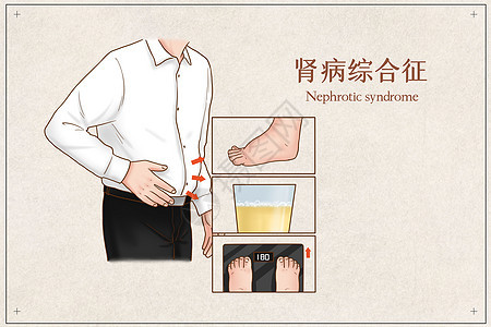 肾病综合征医疗插画水肿高清图片素材