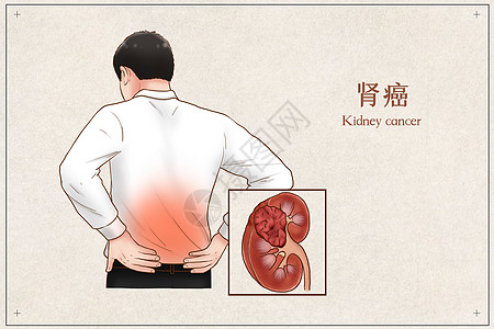 医疗折页肾癌医疗插画插画