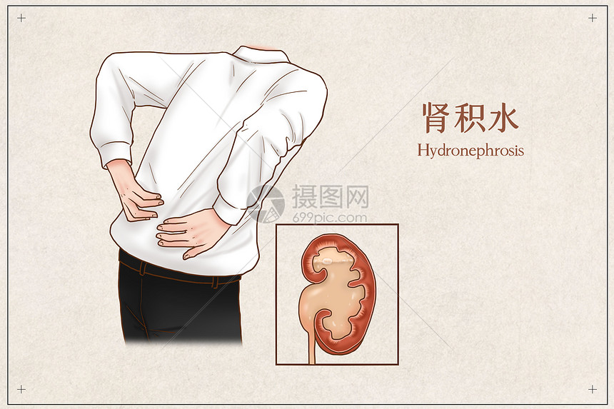 肾积水医疗插画