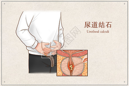 尿道结石医疗插画背景图片