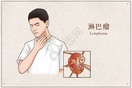 淋巴瘤医疗插画高清图片