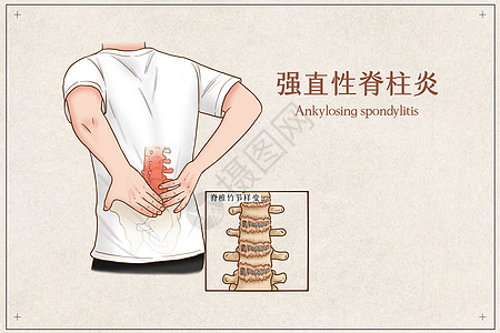 强直性脊柱炎医疗插画背景图片