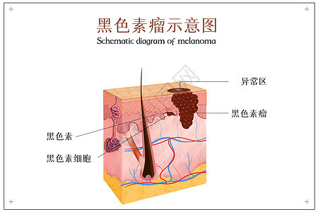 黑色素瘤示意图图片