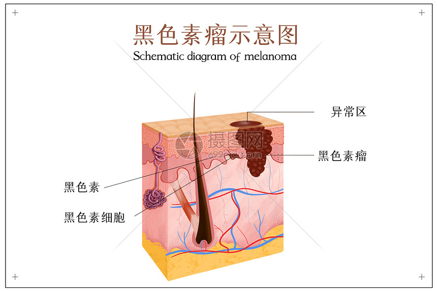 黑色素瘤示意图图片