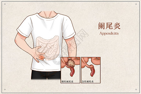 肝胆阑尾炎医疗插画插画