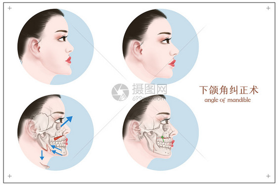 下颌角纠正手术医学医美插画图片