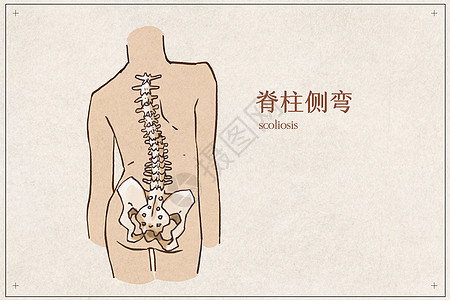 脊柱侧弯病例背景图片