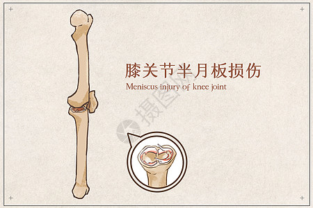 膝盖解剖膝关节半月板损伤插画