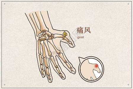 手部痛风病例背景图片