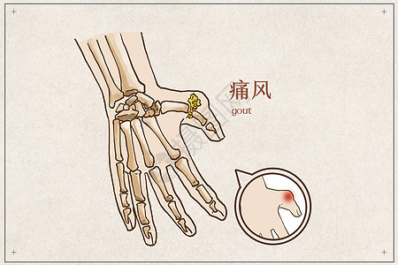 手部痛风病例图片