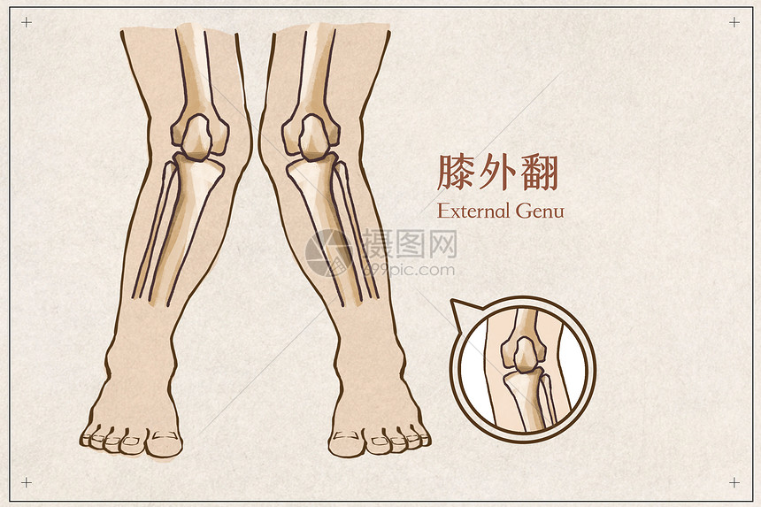 膝外翻医疗插画插画图片下载 正版图片 摄图网