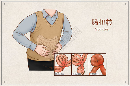 人体器官肠肠扭转医疗插画插画
