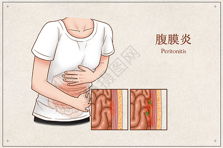 肠道消化吸收腹膜炎医疗插画插画