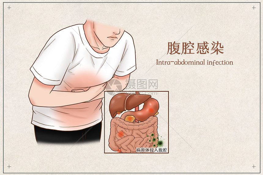 腹腔感染医疗插画图片
