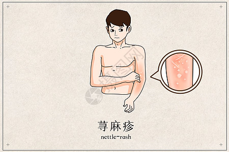 荨麻疹医疗插画图片