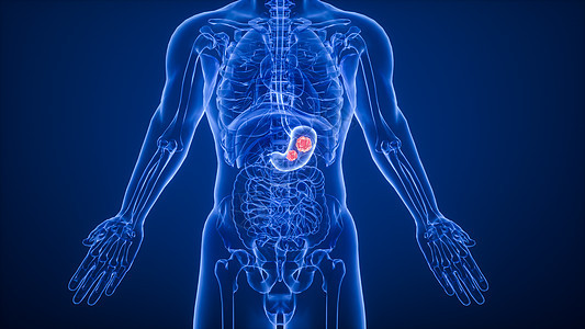 3D胃部疾病图片