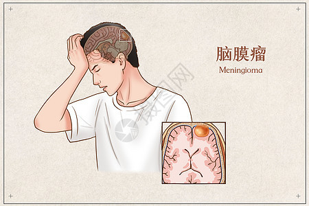 脑膜瘤医疗插画图片