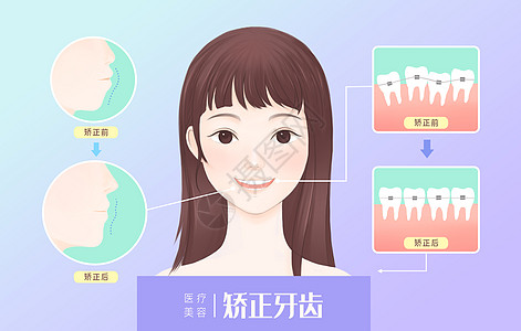 带牙套医疗美容矫正牙齿插画