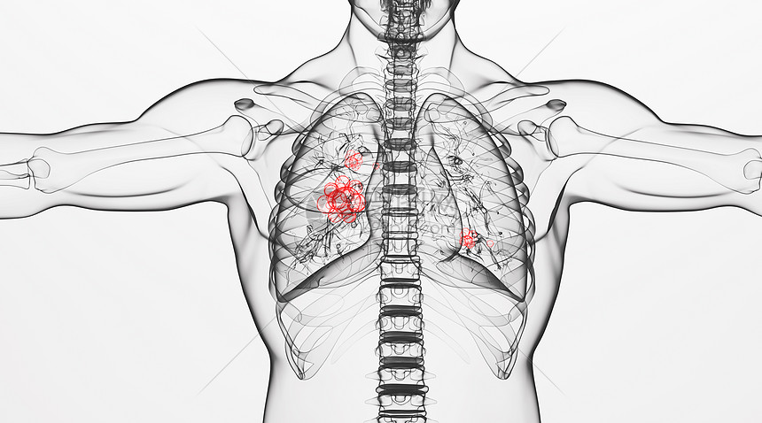 人体肺部病变场景图片