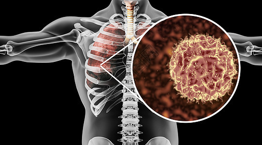 人体肺部病变场景图片