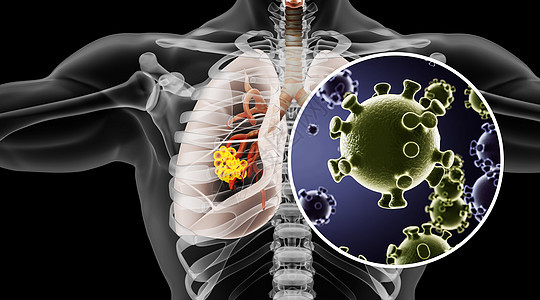 人体肺部病变场景图片