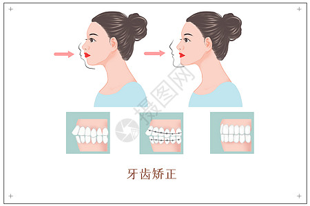 带牙套牙齿矫正医美插画插画