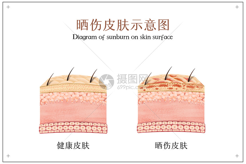 晒伤皮肤示意图图片