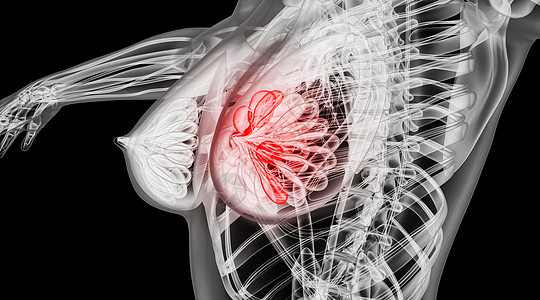 生殖系统人体乳腺病变场景设计图片