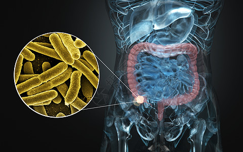 人体肠道疾病图片