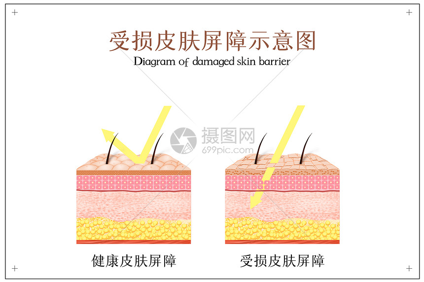受损皮肤屏障示意图插画图片下载-正版图片401799882-摄图网
