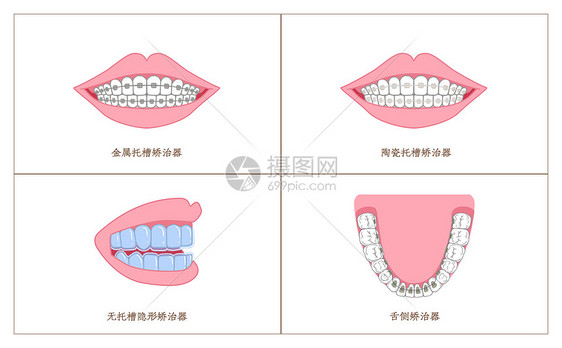 牙齿矫正材料分类科普插画图片