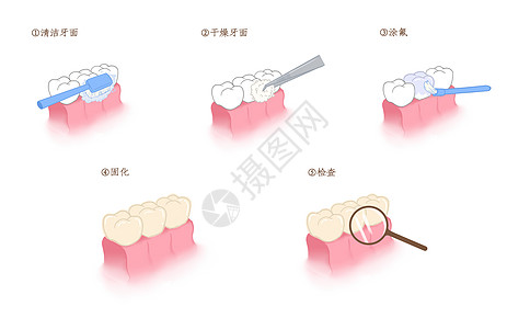 牙齿涂氟步骤科普插画高清图片