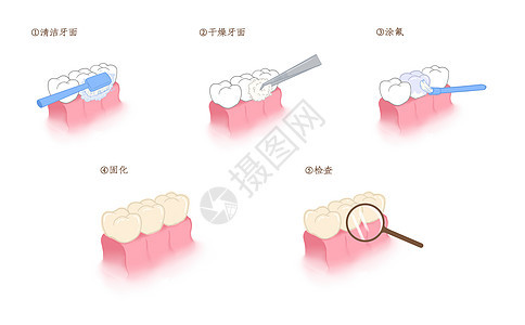 牙齿涂氟步骤科普插画图片