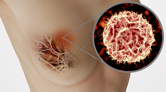 乳腺癌病变场景图片