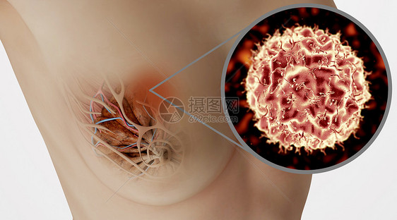 乳腺癌病变场景图片